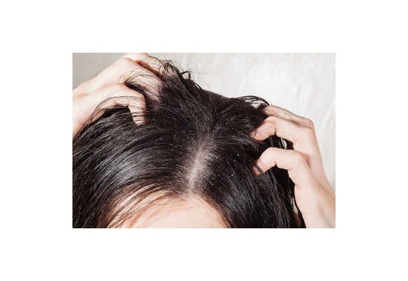 Mastné vlasy, príčiny a starostlivosť