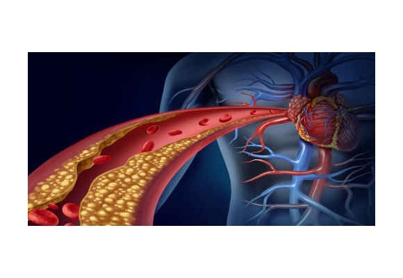 Ateroskleróza - kôrnatenie tepien. Aké sú píčiny, prejavy, dôsledky?